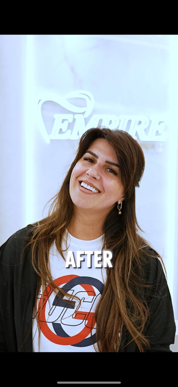 Dopo - Hollywood Smile