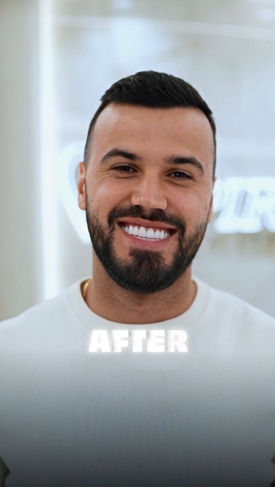 Dopo - Hollywood Smile