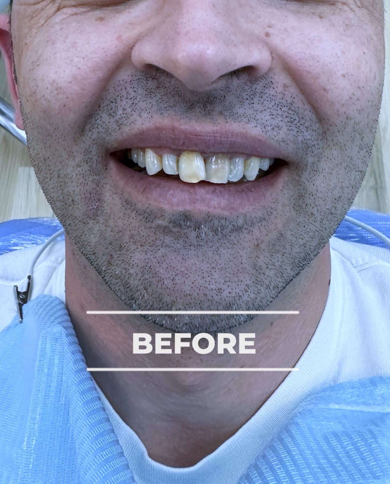 Dopo - Hollywood Smile