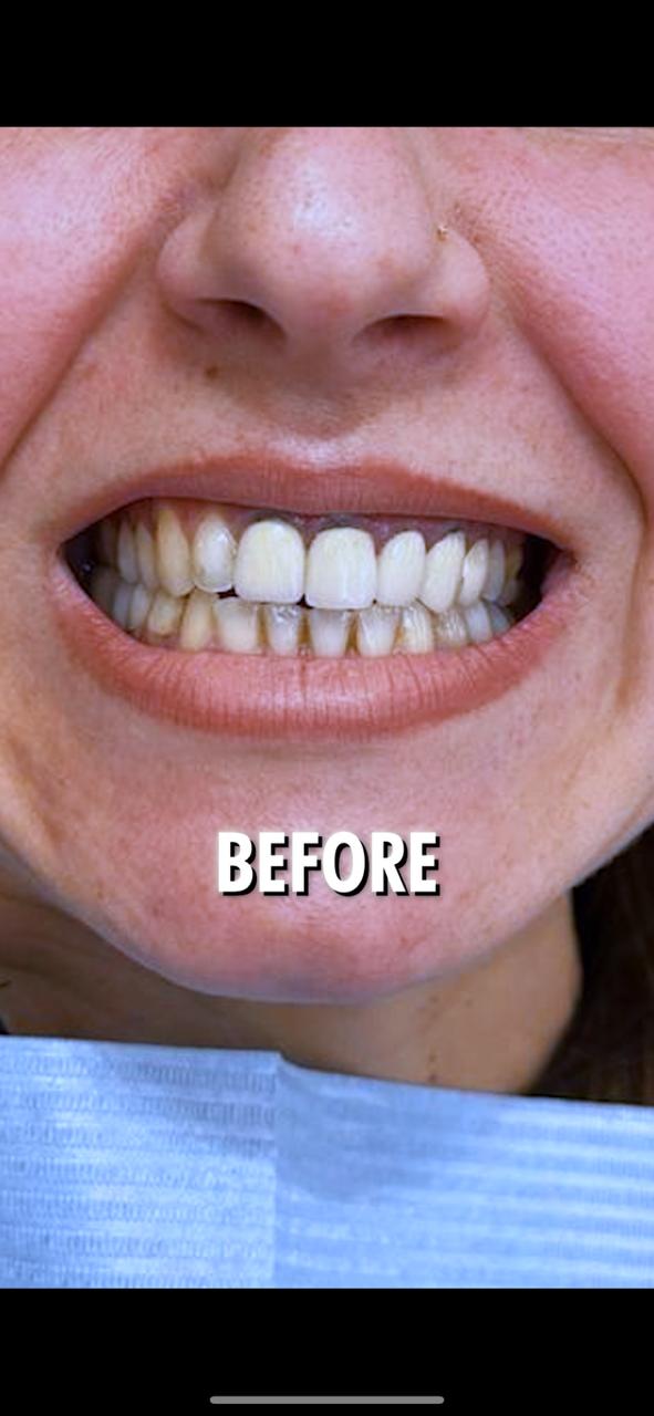 Prima - Hollywood Smile