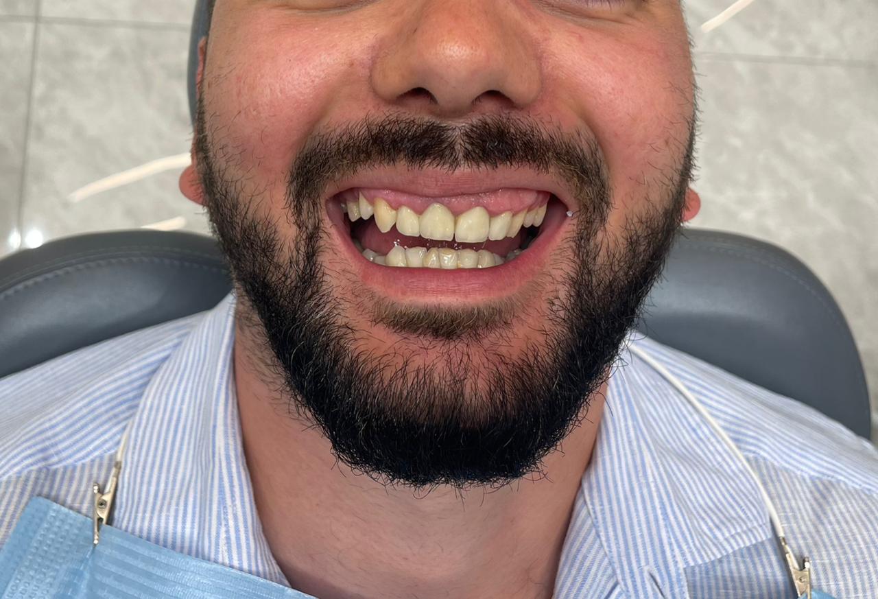 Before - Hollywood Smile