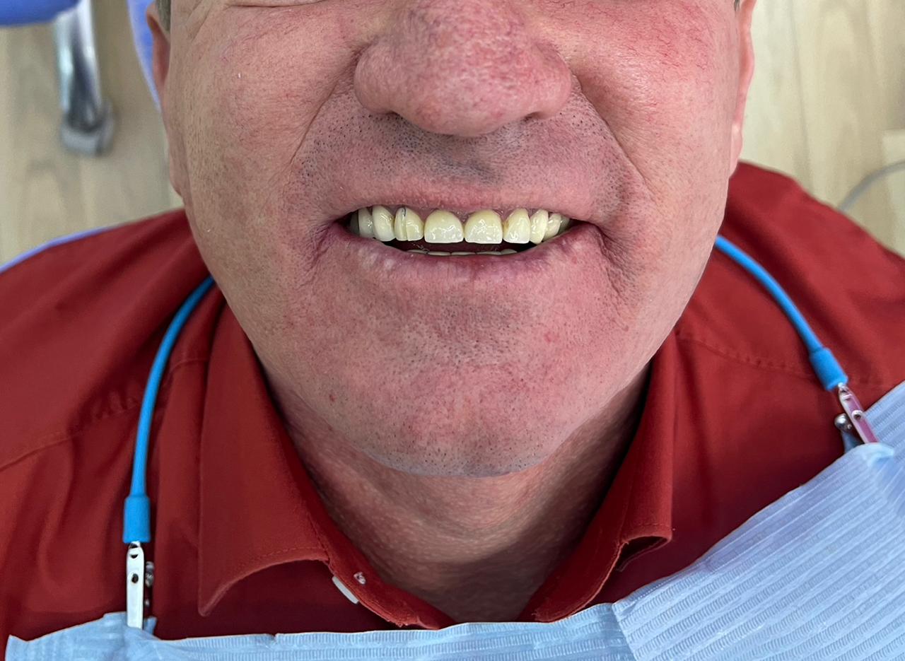 Before - Dental Implants
