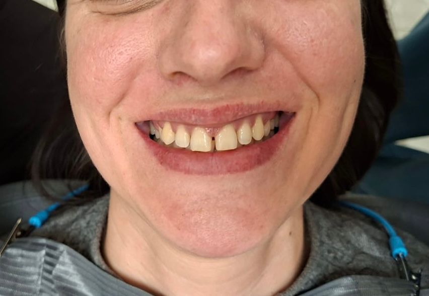 Before - Porcelain Veneers
